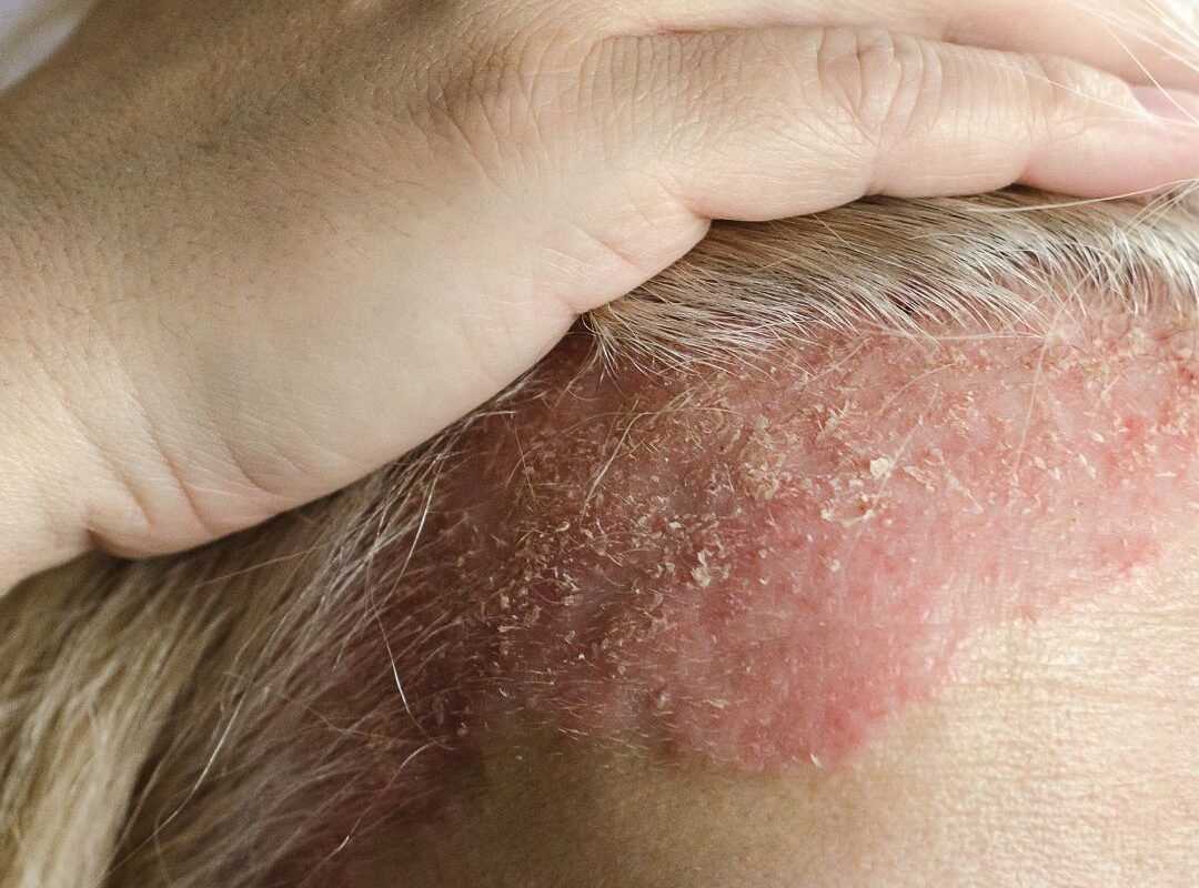 dermatite séborrhéique