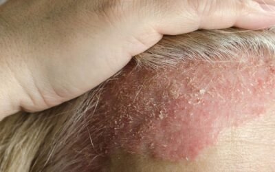 dermatite séborrhéique