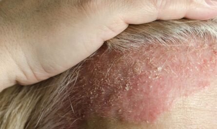 dermatite séborrhéique